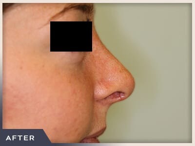 Rhinoplasty Before & After Patient #799