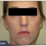 Rhinoplasty Before & After Patient #798