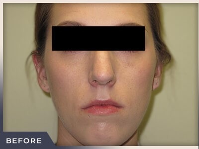Rhinoplasty Before & After Patient #798