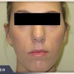 Rhinoplasty Before & After Patient #798
