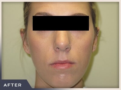 Rhinoplasty Before & After Patient #798