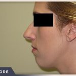 Rhinoplasty Before & After Patient #798