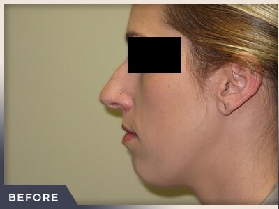 Rhinoplasty Before & After Patient #798