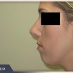 Rhinoplasty Before & After Patient #798