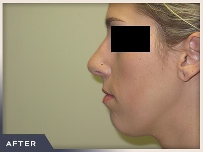 Rhinoplasty Before & After Patient #798