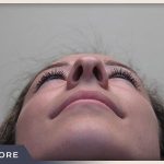 Rhinoplasty Before & After Patient #797