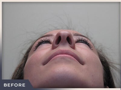 Rhinoplasty Before & After Patient #797
