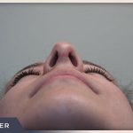 Rhinoplasty Before & After Patient #797
