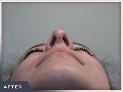 Rhinoplasty Before & After Patient #797