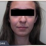 Rhinoplasty Before & After Patient #797