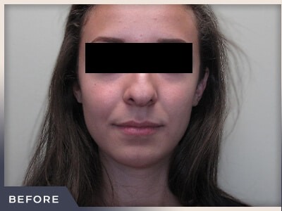 Rhinoplasty Before & After Patient #797