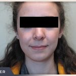 Rhinoplasty Before & After Patient #797
