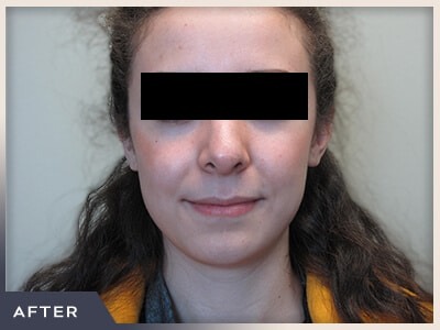 Rhinoplasty Before & After Patient #797