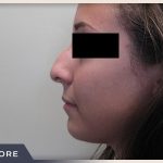 Rhinoplasty Before & After Patient #797