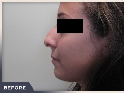 Rhinoplasty Before & After Patient #797