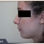 Rhinoplasty Before & After Patient #797