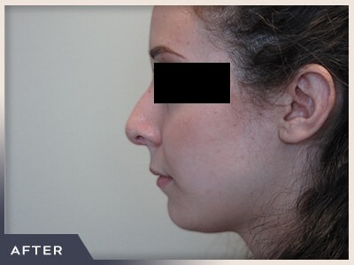 Rhinoplasty Before & After Patient #797