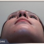 Rhinoplasty Before & After Patient #796