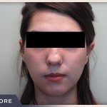 Rhinoplasty Before & After Patient #796