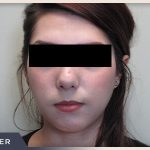 Rhinoplasty Before & After Patient #796
