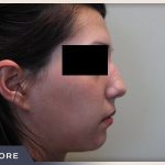 Rhinoplasty Before & After Patient #796