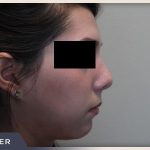 Rhinoplasty Before & After Patient #796