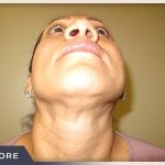Rhinoplasty Before & After Patient #795