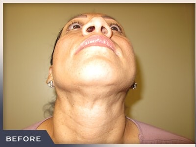 Rhinoplasty Before & After Patient #795