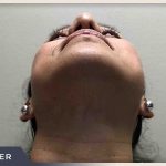 Rhinoplasty Before & After Patient #795