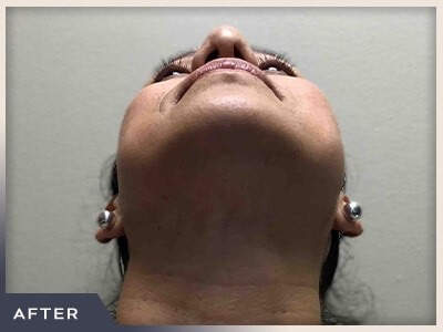 Rhinoplasty Before & After Patient #795