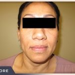 Rhinoplasty Before & After Patient #795