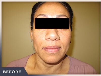 Rhinoplasty Before & After Patient #795