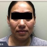 Rhinoplasty Before & After Patient #795