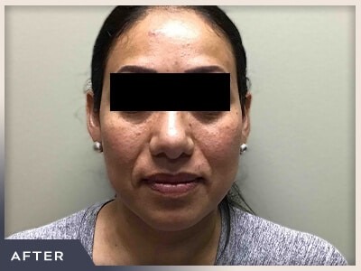 Rhinoplasty Before & After Patient #795
