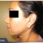 Rhinoplasty Before & After Patient #795