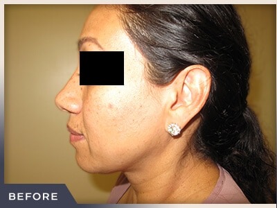 Rhinoplasty Before & After Patient #795