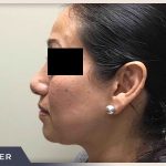 Rhinoplasty Before & After Patient #795