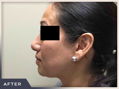 Rhinoplasty Before & After Patient #795