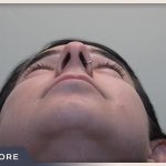 Rhinoplasty Before & After Patient #794