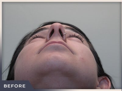 Rhinoplasty Before & After Patient #794