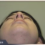 Rhinoplasty Before & After Patient #794