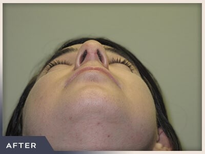 Rhinoplasty Before & After Patient #794