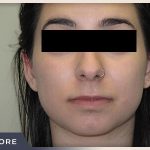Rhinoplasty Before & After Patient #794