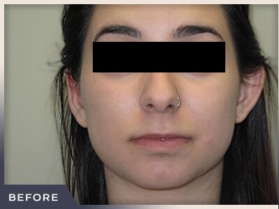 Rhinoplasty Before & After Patient #794