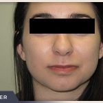 Rhinoplasty Before & After Patient #794