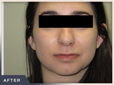 Rhinoplasty Before & After Patient #794