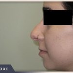 Rhinoplasty Before & After Patient #794
