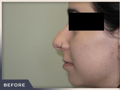 Rhinoplasty Before & After Patient #794