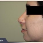 Rhinoplasty Before & After Patient #794