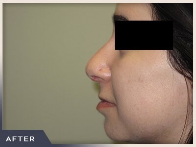 Rhinoplasty Before & After Patient #794